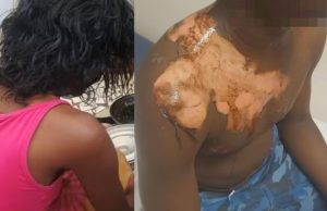 Six mois de prison ferme pour une épouse ayant ébouillanté son mari à Touba